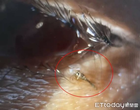 ▲一名患者來檢查眼睛，發現搖擺蚊飛進眼中存活3日             。（圖／記者吳奕靖翻攝）