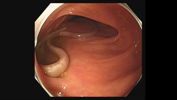 ▲▼腸胃內科醫師經由大腸鏡檢查在病人腸道中發現蛔蟲。（圖／大林慈濟醫院提供）