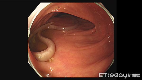▲▼   體重減輕很開心？ 原來是這原因作怪   。（圖／大林慈濟醫院提供）