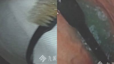 吃播後催吐「竟吞下整支牙刷」! 陸網紅摀脖急就醫…掉進去了