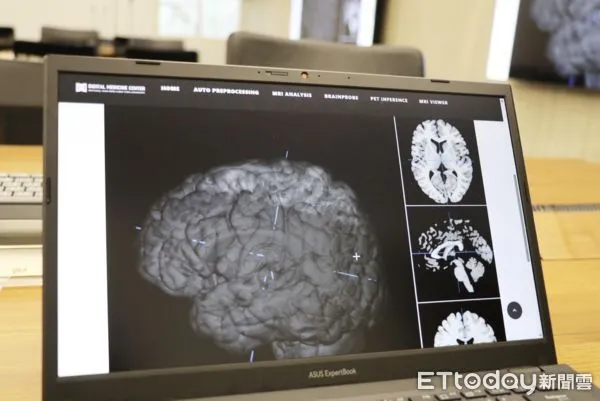 陽明交大和北榮開發出領先全球的腦影像分析技術。（圖／陽明交大提供）