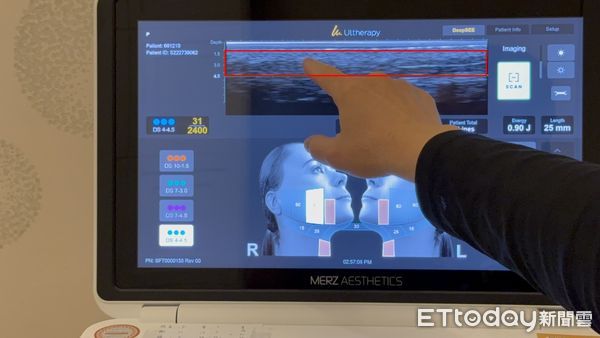 ▲超音波影像應用在臉部微整技術            。（圖／記者吳奕靖攝）