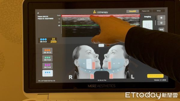 ▲超音波影像應用在臉部微整技術            。（圖／記者吳奕靖攝）