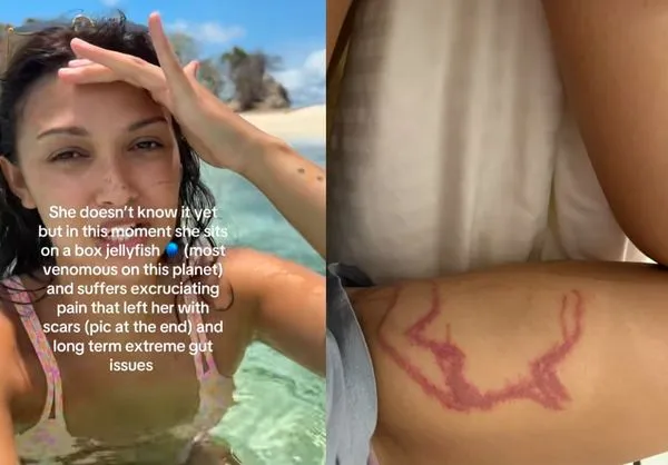 女網紅拍片被「世界最毒水母」螫傷　爆痛留恐怖血痕：慘叫1小時。（圖／翻攝自TikTok／julieanddaniel_）