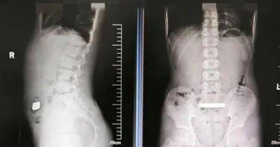 11歲弟腹部墜脹!X光驚見「高密度金屬」 醫取出金條傻眼