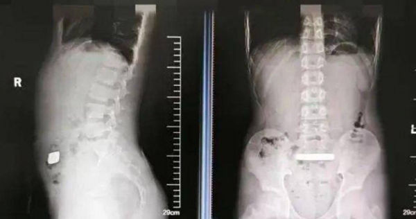 11歲弟腹脹送醫！X光驚見「高密度金屬」　醫取出100克金條傻眼