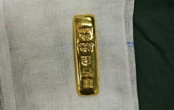 11歲弟腹脹送醫！X光驚見「高密度金屬」　醫取出100克金條傻眼