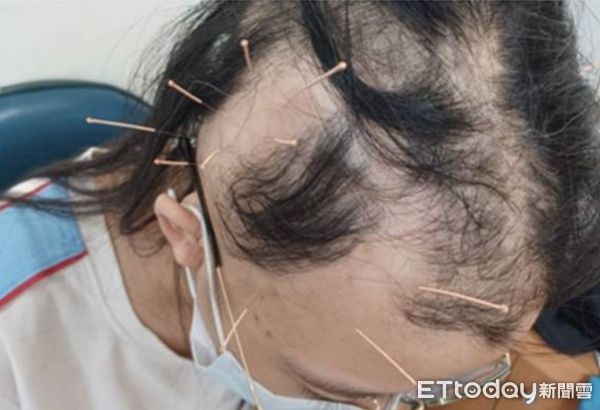 ▲鬼剃頭。（圖／豐原醫院提供）