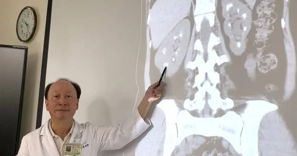 台中OL「2年5度腎結石」腰痛就醫　醫揪雙腎像「滿天星」原因曝光