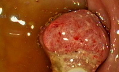 醫曝「三個雞婆」揪大腸癌　台積電女員工淚：謝謝你們救我
