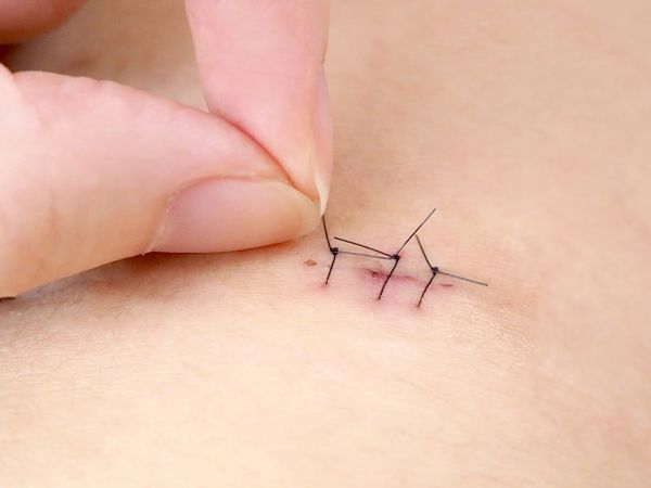 印度一名男子因腹痛難耐，居然從YouTube自學開刀，在家自行開腹手術並縫合。（示意圖，photoAC）