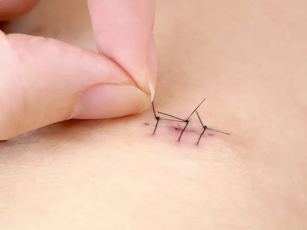 印度一名男子因腹痛難耐，居然從YouTube自學開刀，在家自行開腹手術並縫合。（示意圖，photoAC）