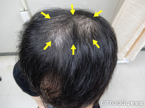 ▲30多歲男主管禿頭以為遺傳　就診一驗竟是「梅毒二期」。（圖／記者游瓊華翻攝）