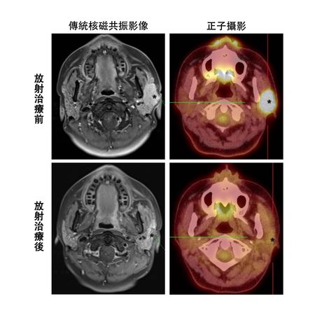 ▲▼長庚精準醫療再突破-正子攝影可準確評估唾液腺癌放射治療效果。（圖／長庚醫院提供）