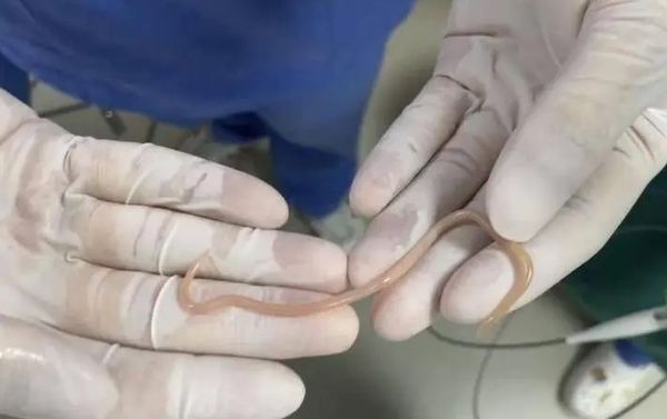 ▲▼深圳45歲女子常無故腹痛，腸道揪出10餘公分長活體蟲子。（圖／翻攝自微博）