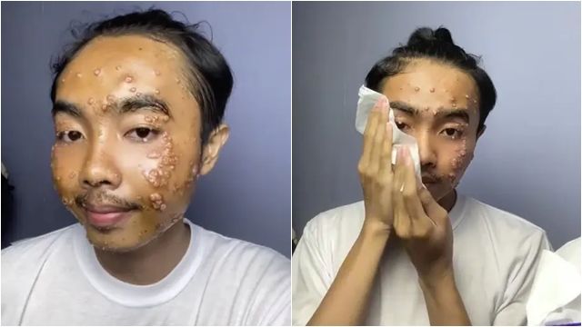 ▲▼恐怖顆粒爬滿臉！他買二手衣「沒洗直接穿」　爛臉警世片瘋傳。（圖／翻攝TikTok@onenevertwoo_one）