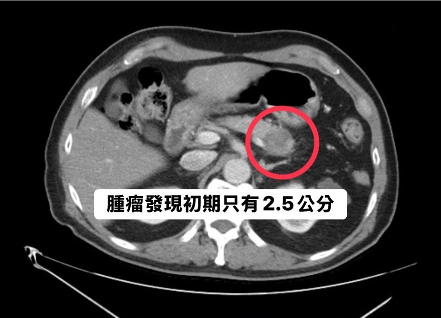 ▲▼林相宏表示，一名病患腫瘤經過3個月，已經大了一半。（圖／翻攝「胰臟醫師林相宏 禾馨民權內科診所」臉書）