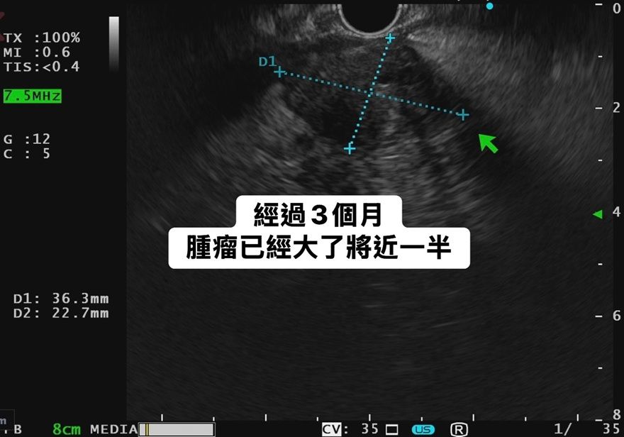 ▲▼林相宏表示，一名病患腫瘤經過3個月，已經大了一半。（圖／翻攝「胰臟醫師林相宏 禾馨民權內科診所」臉書）