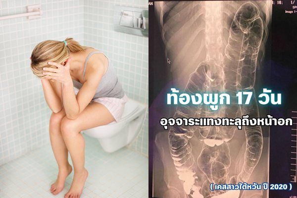 ▲▼台灣一名女子因嚴重便秘，最後結腸被刺穿的病例最近在泰國引發重視。（組圖／VCG、翻攝自Facebook）