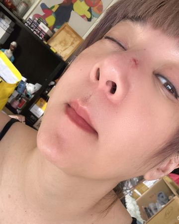 ▲陸元琪面部著地，導致鼻樑受傷。（圖／翻攝自Facebook／陸元琪）