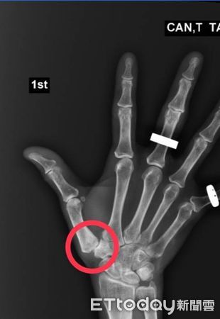 ▲高姓女子右手大拇指退化、操過頭，痛了2年都睡不好覺。（圖／記者許宥孺翻攝）