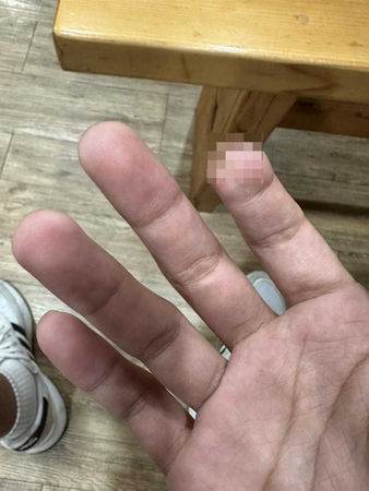 這起事故造成王員右手食指第貳指創傷性截肢、全身多處擦挫傷。（圖／翻攝畫面）