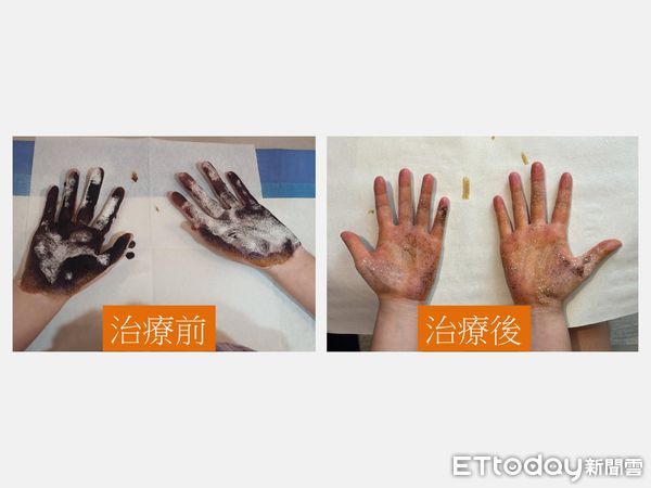 ▲手汗,狐臭,大里仁愛醫院。（圖／大里仁愛醫院提供）