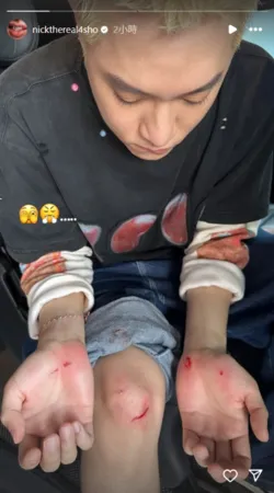 ▲周湯豪曬出擦傷照。（圖／翻攝自周湯豪IG）