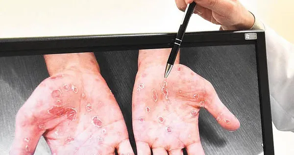 梅毒症狀很複雜，部分患者初期毫無症狀，直到二期才會出現全身紅疹，若不及時治療，惡化至晚期甚至可能導致全身癱瘓。（示意圖／報系資料照）