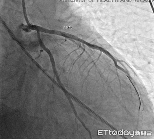 ▲▼  64歲男子院前心跳停止倒地醫院門口 嘉義醫院團隊聯手搶救 心導管手術火速開通血管 成功挽回一命  。（圖／嘉義醫院提供）