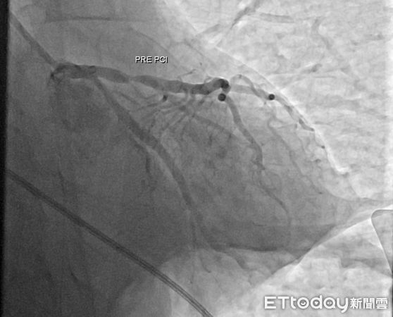 ▲▼  64歲男子院前心跳停止倒地醫院門口 嘉義醫院團隊聯手搶救 心導管手術火速開通血管 成功挽回一命  。（圖／嘉義醫院提供）