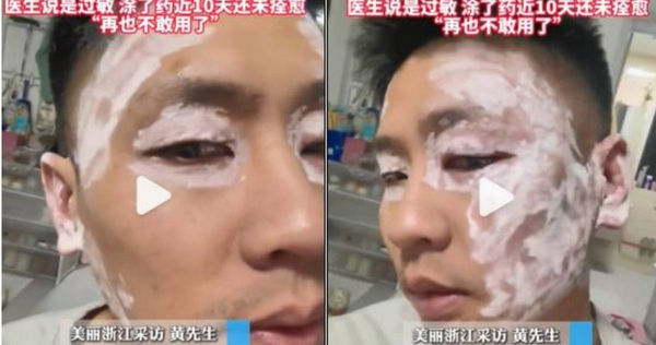 男子隨手取用餐廳的紙巾，導致臉部紅腫。（圖／翻攝自微博／大象新聞）