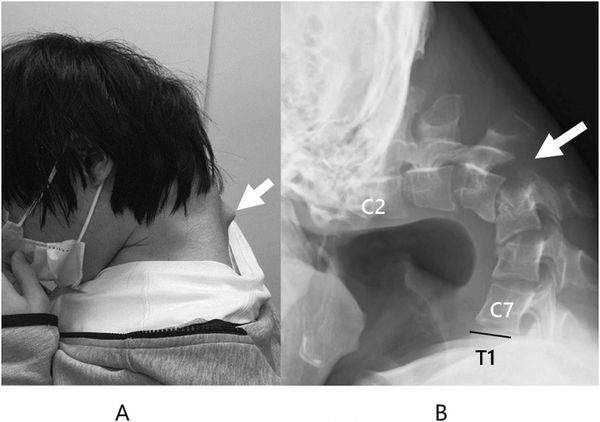 男子頸椎已經變形移位，出現疤痕組織。（圖／翻攝自Science Direct）