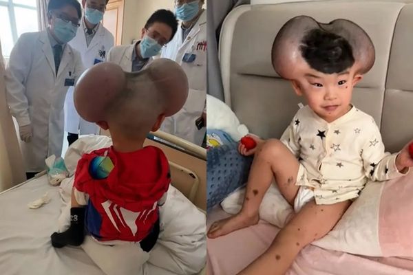 ▲▼3歲童罹罕病！頭長巨痣被嘲「米奇」　手術成功終於笑了。（圖／翻攝自微博）