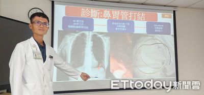 超罕見!台中女鼻胃管打結卡肚內 醫拉出傻眼「管子變黑又硬」