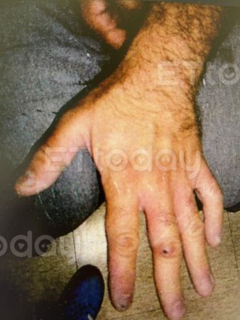 ▲冷氣師傅不知洗劑成分含化骨水，手部浸泡一下午慘中毒府蝕。（圖／黃展慶醫師提供）