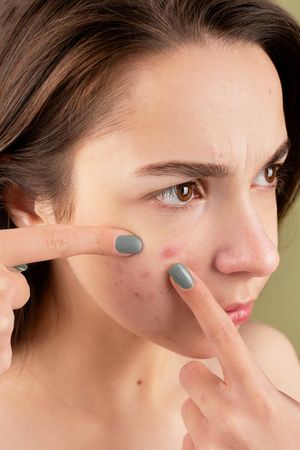 ▲▼「5個日常壞習慣」讓痘痘冒不停             。（圖／Pexels）