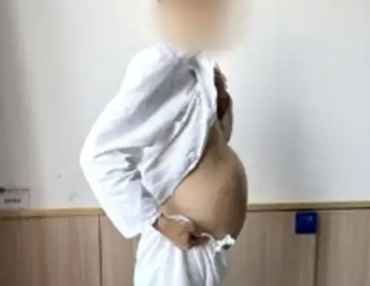 ▲大陸一名男子便祕4個月，腹部隆起如孕婦，經醫生開刀後取出2公尺壞死結腸。（圖／翻攝荔枝新聞）