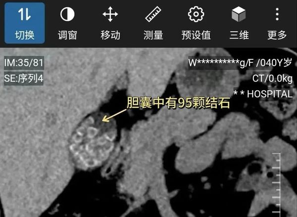 ▲▼患者體內的結石。（圖／翻攝廣州日報）