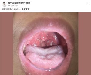 這波新冠常見急性喉炎！中醫曝白膿塊照示警：恐釀氣管發炎、肺炎