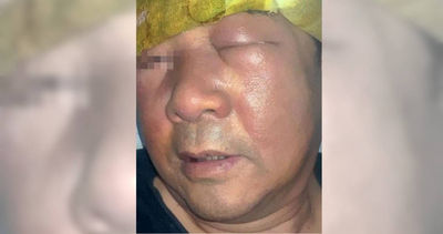 男愛挖鼻孔引發「丹毒」！臉腫成豬頭睜不開眼　高風險族群曝光