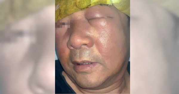 大陸江蘇省淮安市一名66歲的張姓男子（化姓）平時經常挖鼻孔，近日眼瞼、雙頰、鼻部突然出現紅腫。（圖／翻攝自微博）