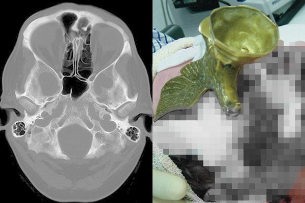 ▲▼英國一名男子酒後被絆倒，導致眼窩被雕像刺穿失明。（圖／翻攝自CMTR期刊）