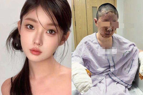 點菸釀火！27歲陸美妝網紅遭「毀容式燒傷」　她哽咽：家變廢墟