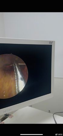 ▲柳岩喝湯卡魚刺就醫。（圖／翻攝自柳岩微博）