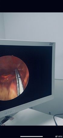 ▲柳岩喝湯卡魚刺就醫。（圖／翻攝自柳岩微博）