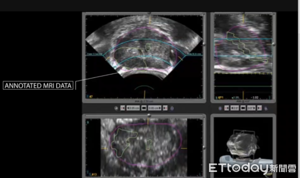 ▲屏基引進海福刀治療攝護腺癌             。（圖／屏基提供）