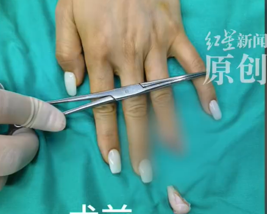 ▲▼術前與術後對比。（圖／翻攝自微博）