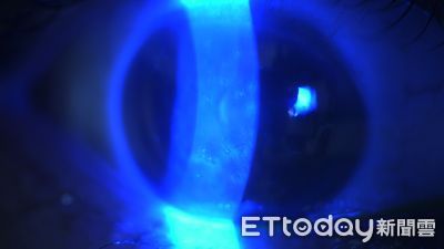 男泡溫泉竟感染「微孢子蟲」!視力降到0.6 醫示警去3地點小心