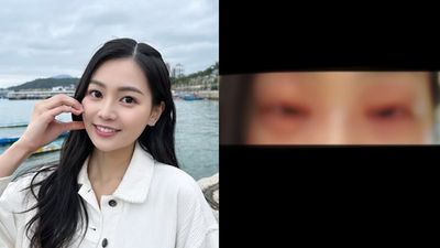27歲香港小姐嚴重食物過敏急送醫! 「雙眼腫脹」驚悚畫面曝